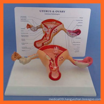 Human Size Female Uterus Ovary Anatomy Model Showing Common Pathologies